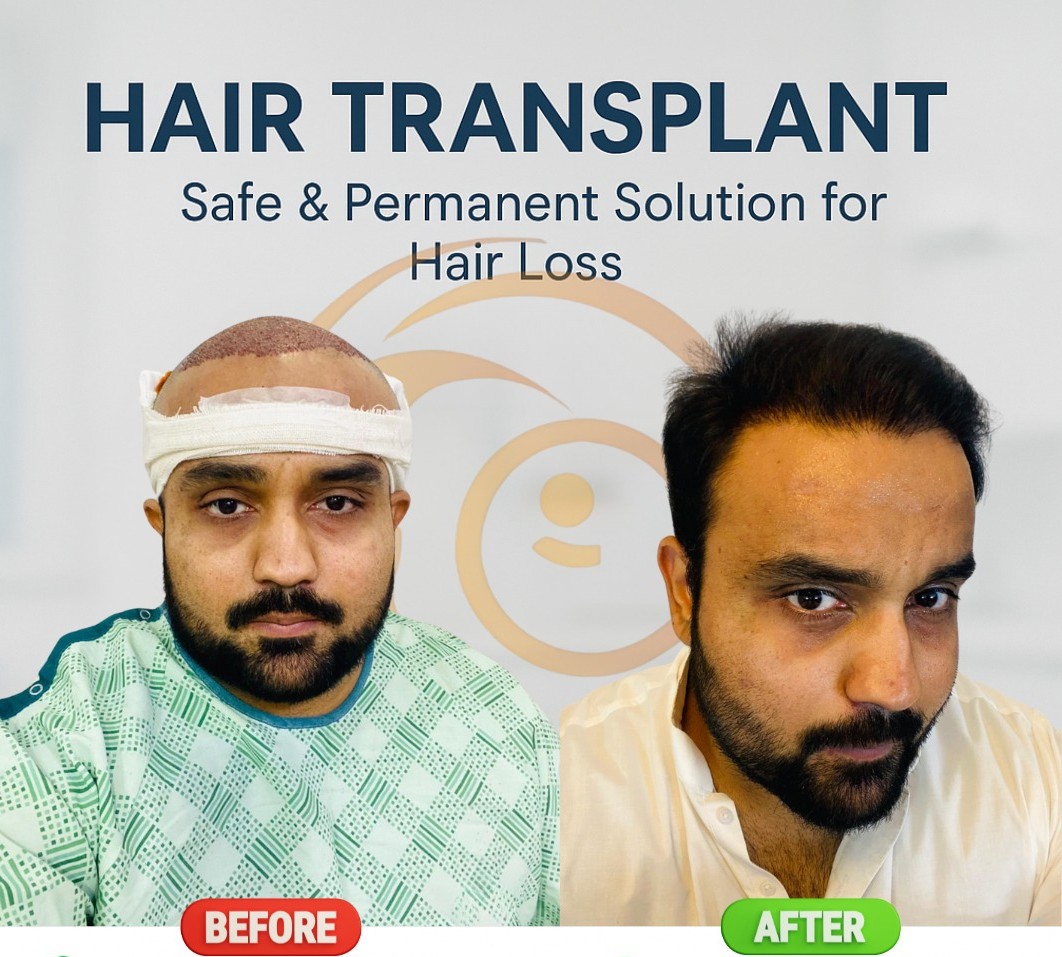 Hair Transplant Results Timeline