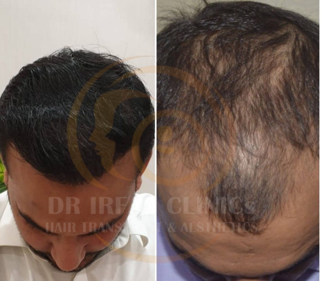 Hair Transplant Results Timeline