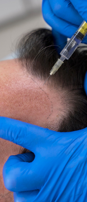 Hair transplant consultation at Dr. Irfan Clinics, Karachi