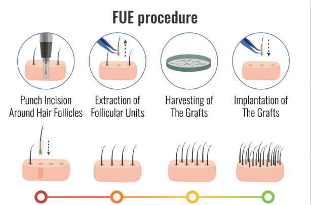 FUE Hair Transplant Overview - Karachi