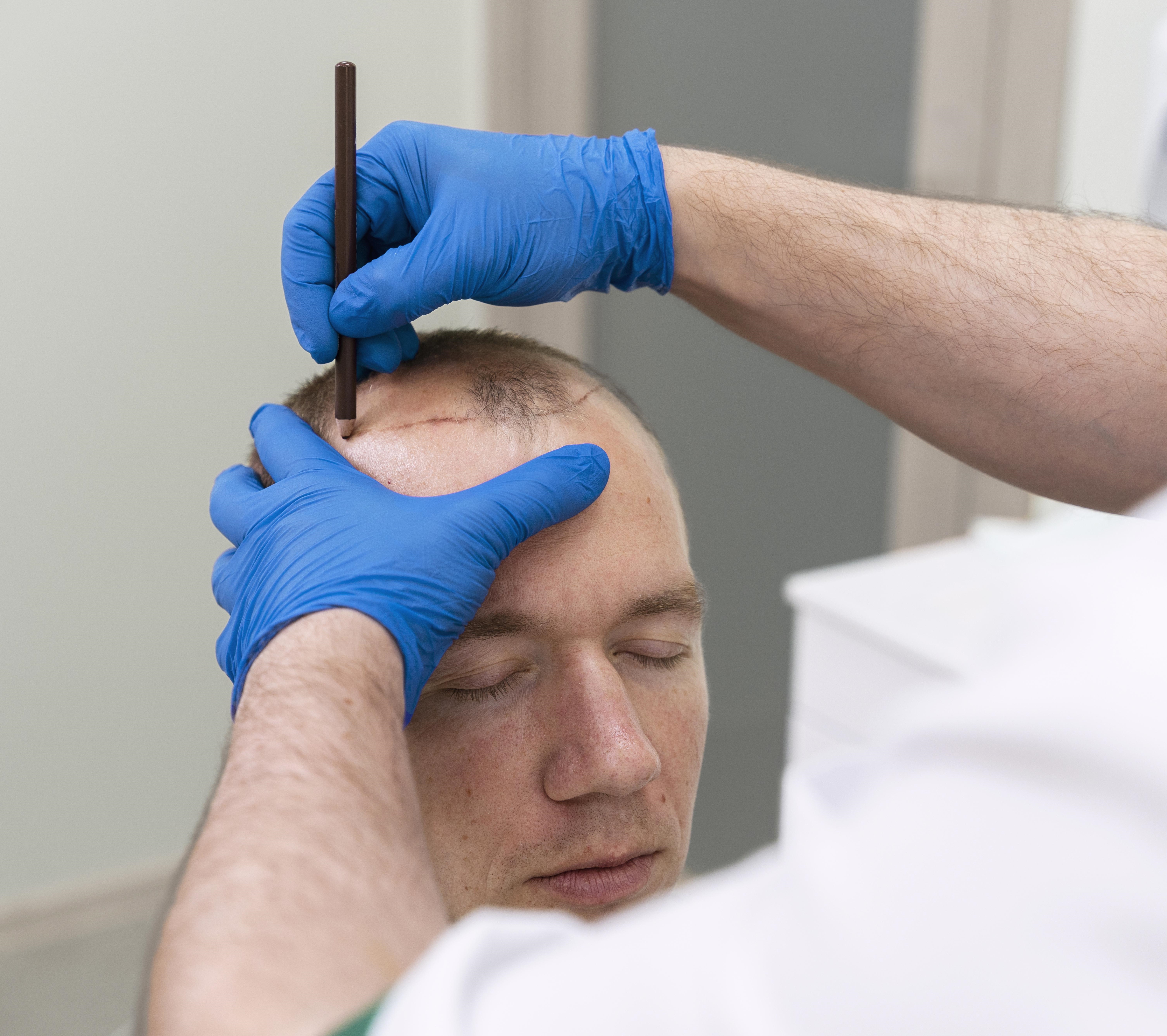 hair-transplant-in-karach-dr-irfan-clinics